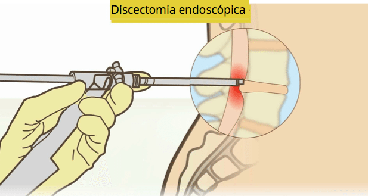 Hérnia de Disco: o que é, Sintomas, Tratamento, Cirurgia, Tem Cura?