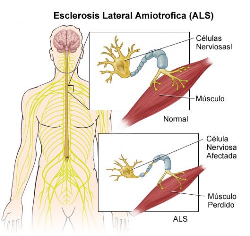 O que é Esclerose Lateral Amiotrófica (ELA), Sintomas, Tem Cura?